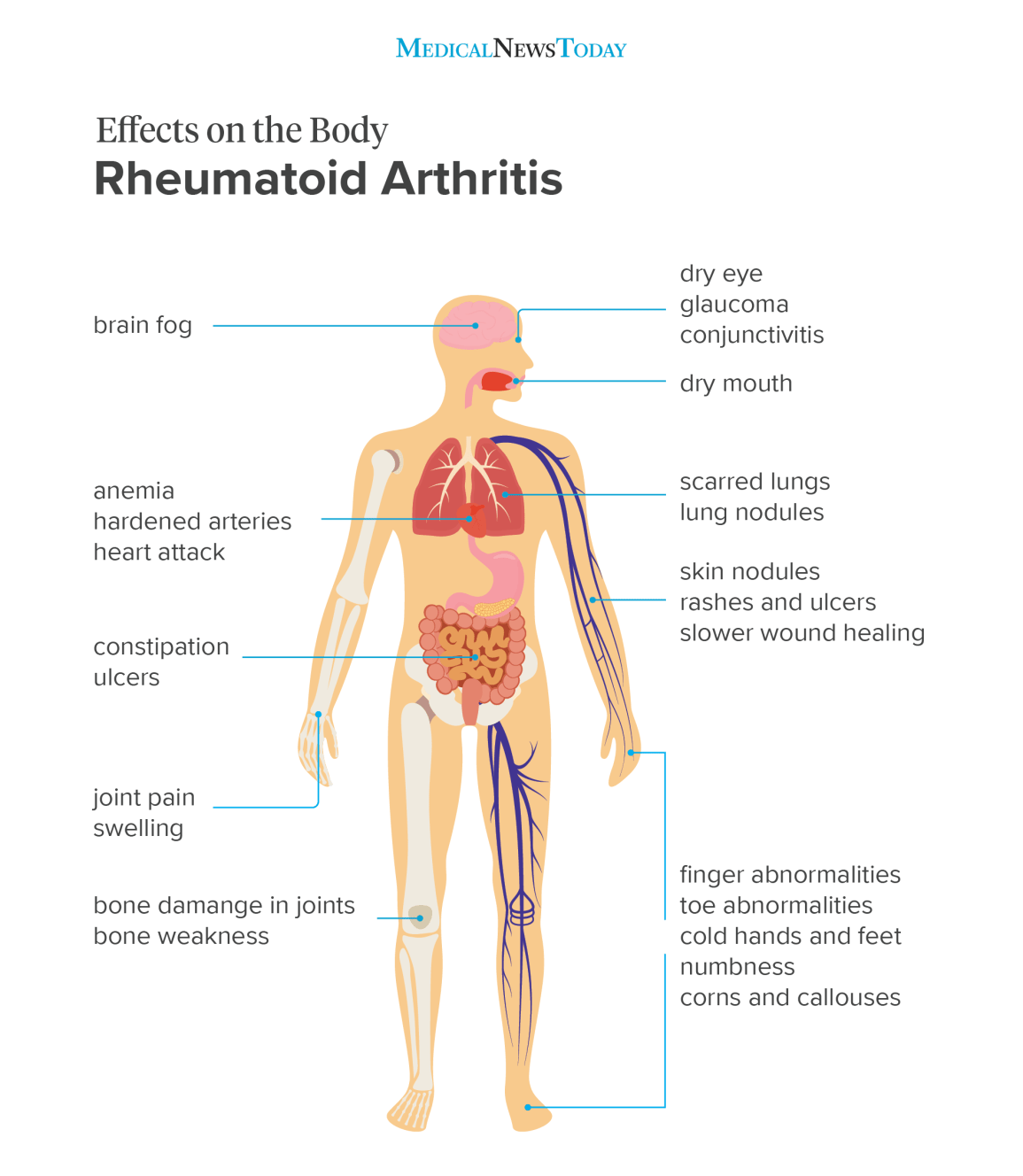 Rheumatoid arthritis (RA): Signs and symptoms