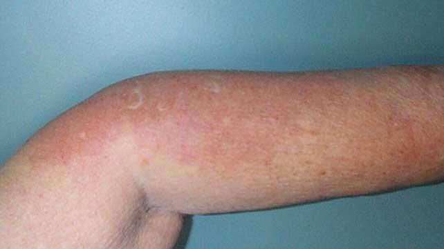 Rheumatoid arthritis rash: Causes, symptoms, and images