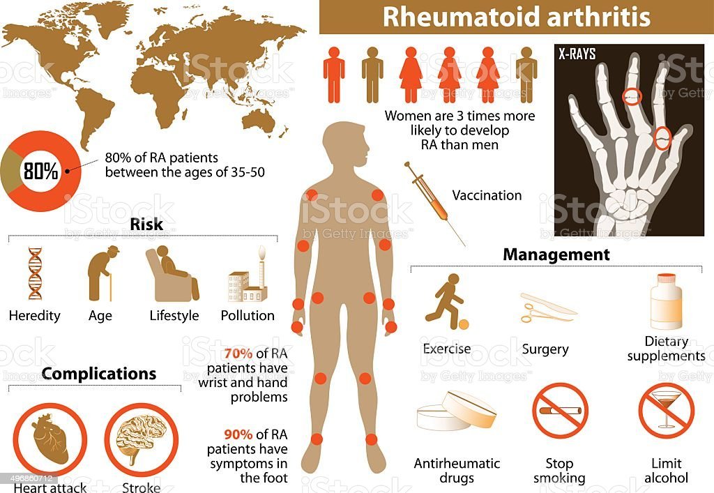 Rheumatoid Arthritis Stock Illustration