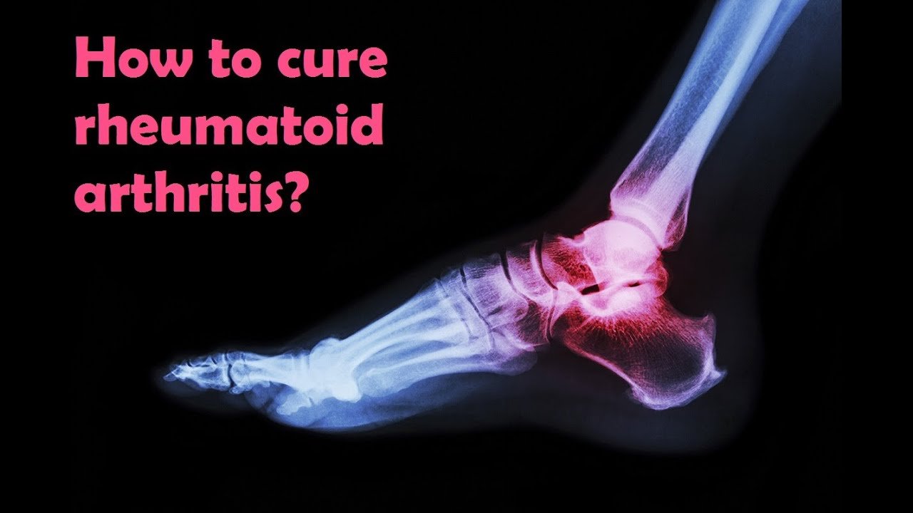 Rheumatoid arthritis. The symptoms and treatment. As ...