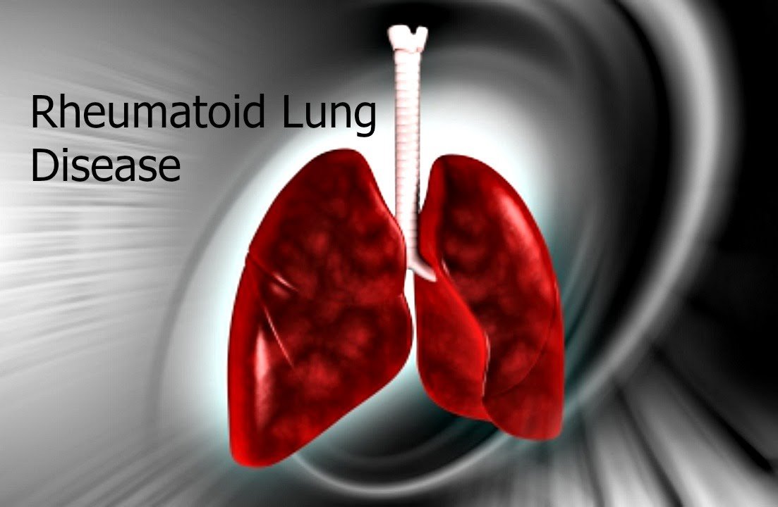 Rheumatoid Lung Disease