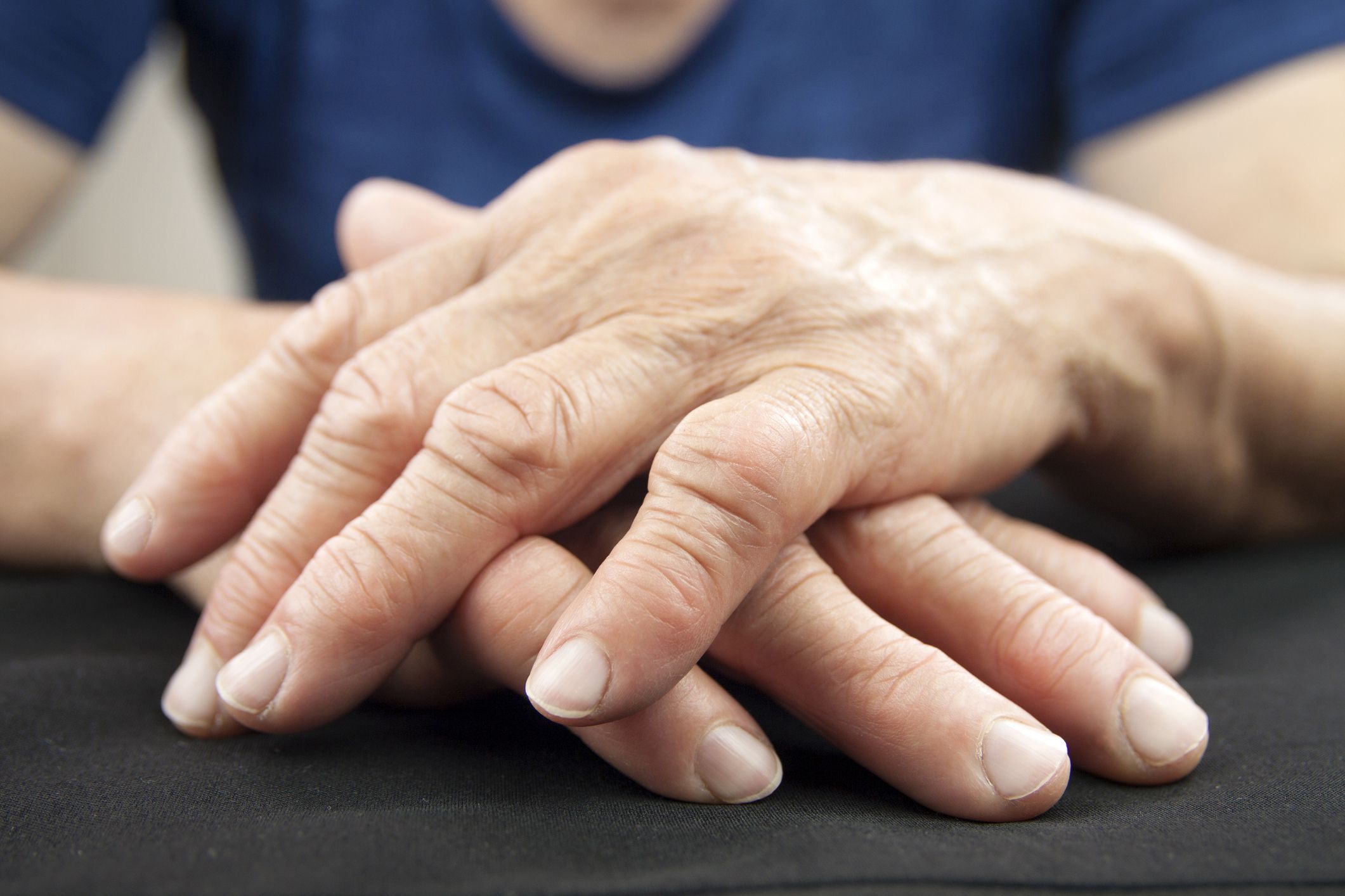 Risk of Hand Deformity in Rheumatoid Arthritis