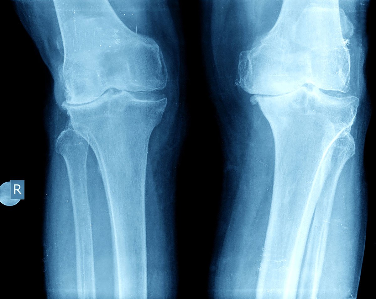 Running: Can it damage your knee?