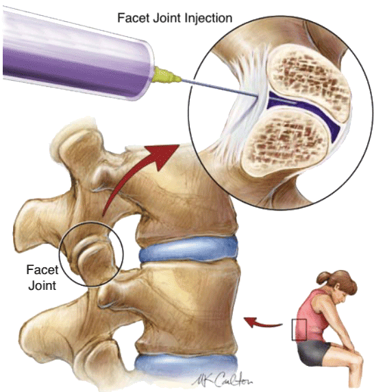 Short Term Treatments for Back Pain