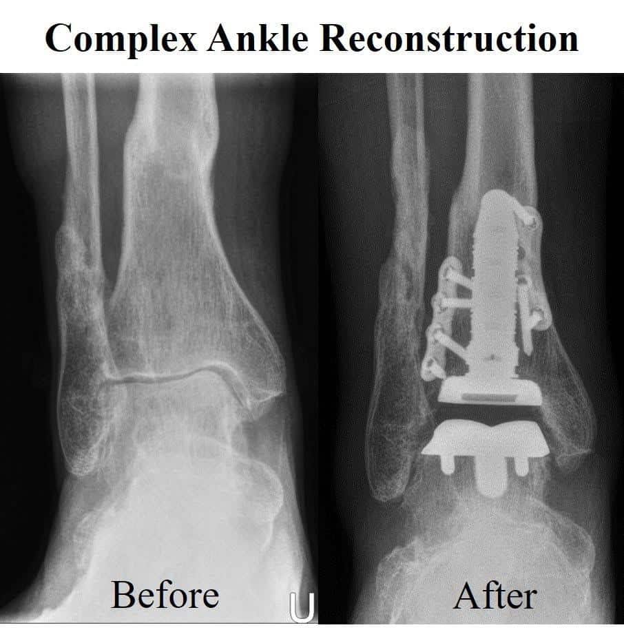 Should I consider an Ankle Replacement for for my Ankle Arthritis?: Tri ...