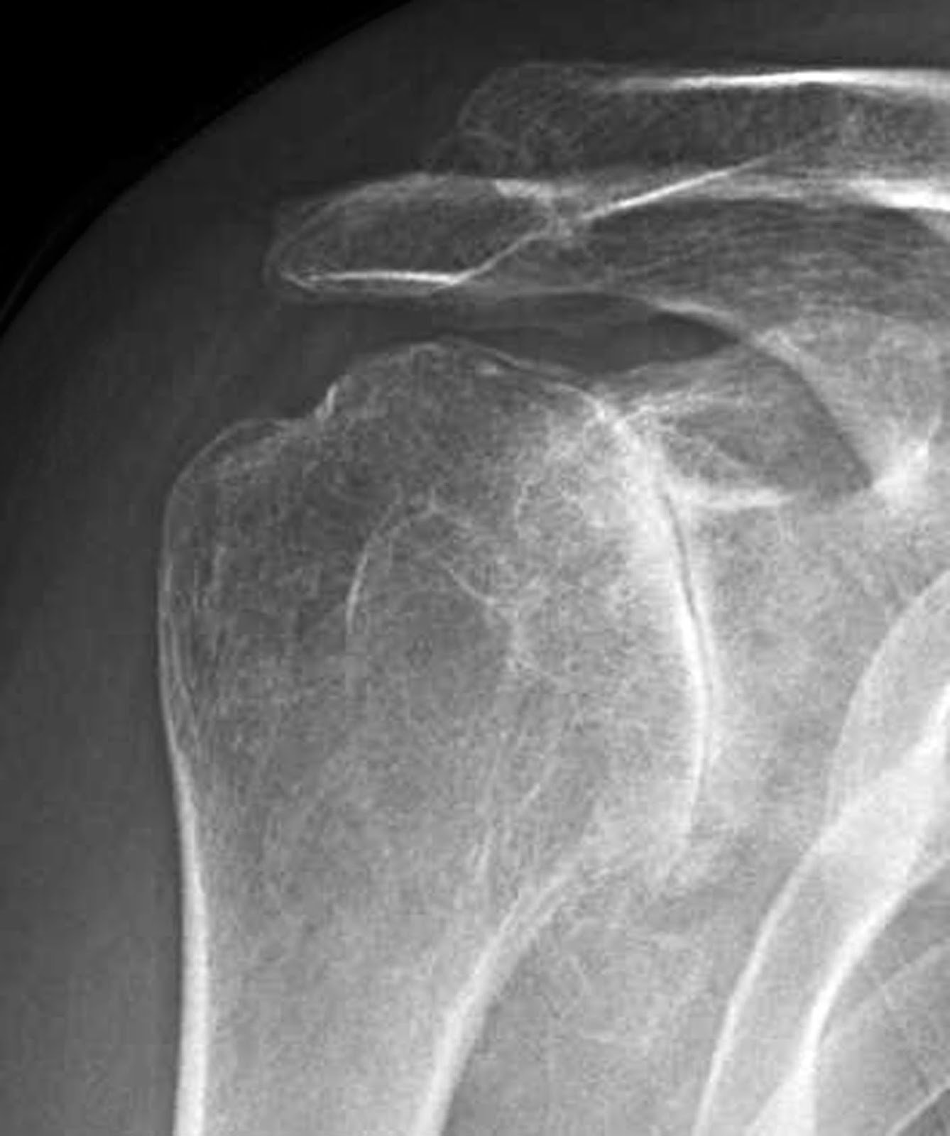 Shoulder Arthritis / Rotator Cuff Tears: causes of ...