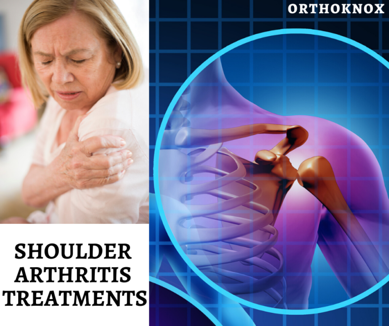 Shoulder Arthritis Treatments