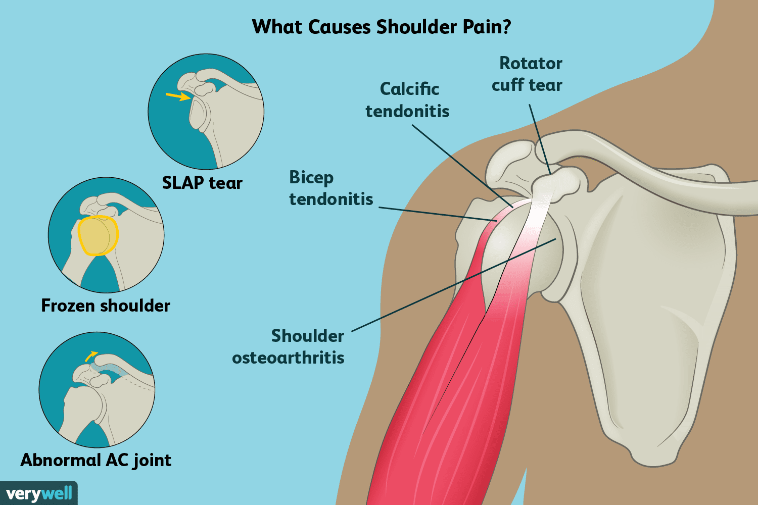 Shoulder Pain: Causes, Treatment, and When to See a ...