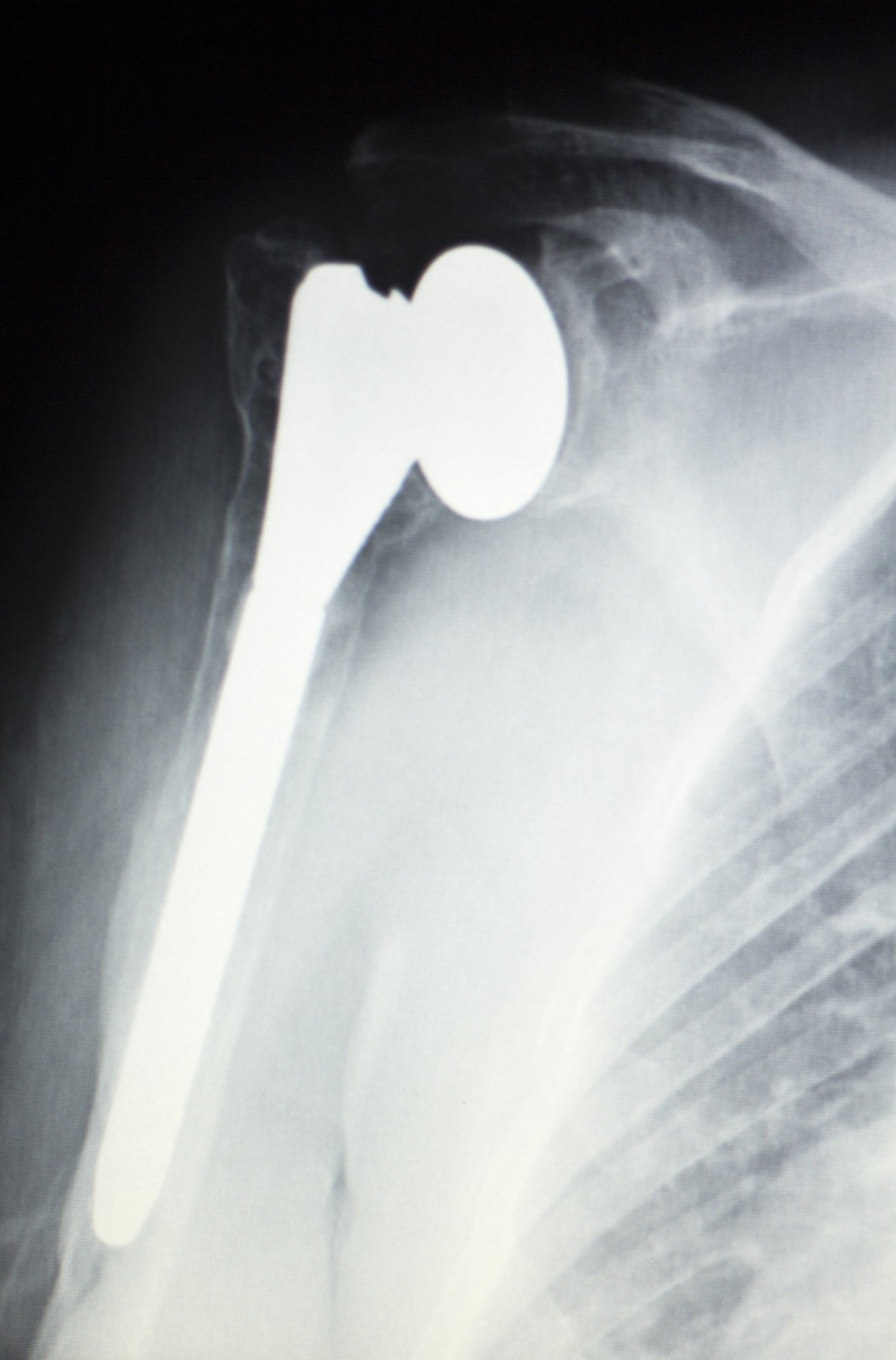 Shoulder Replacement Surgery: Traditional vs. Reverse ...