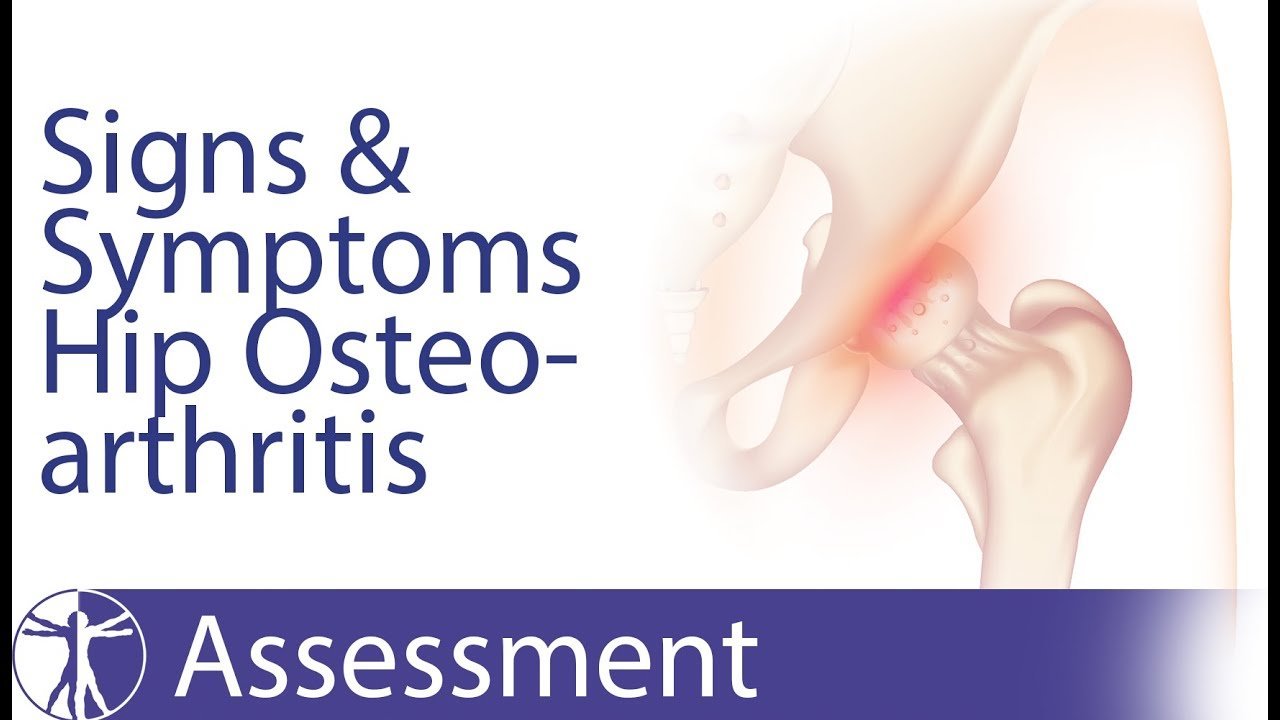 Signs and Symptoms of Hip Osteoarthritis