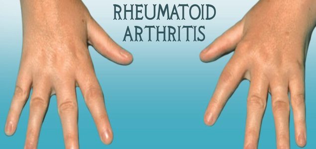 Signs Of Rheumatoid Arthritis In Your Hands