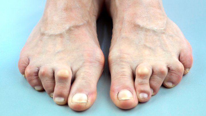 Simple, natural ways to treat all common foot problems ...