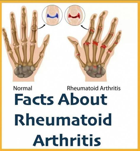 Simple Steps On How To Get Rid Of Arthritis