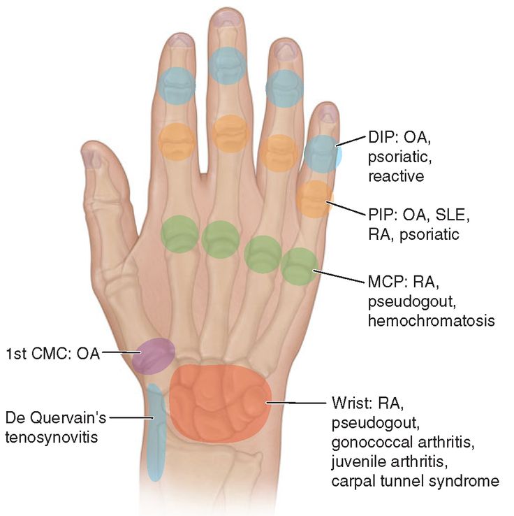 Sites of hand or wrist involvement and their potential disease ...