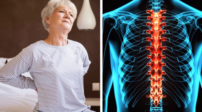 Spinal Arthritis: Causes, Symptoms and Treatments