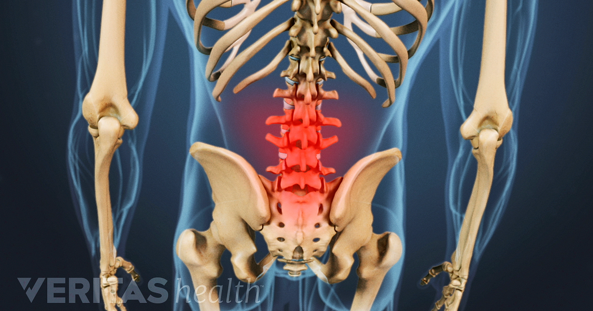 Spinal Osteoarthritis Symptoms