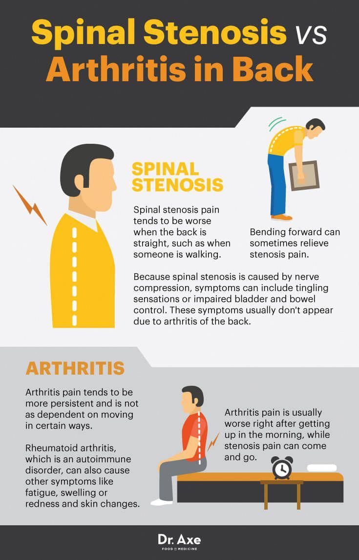 Spinal Stenosis Symptoms, Causes &  Treatments