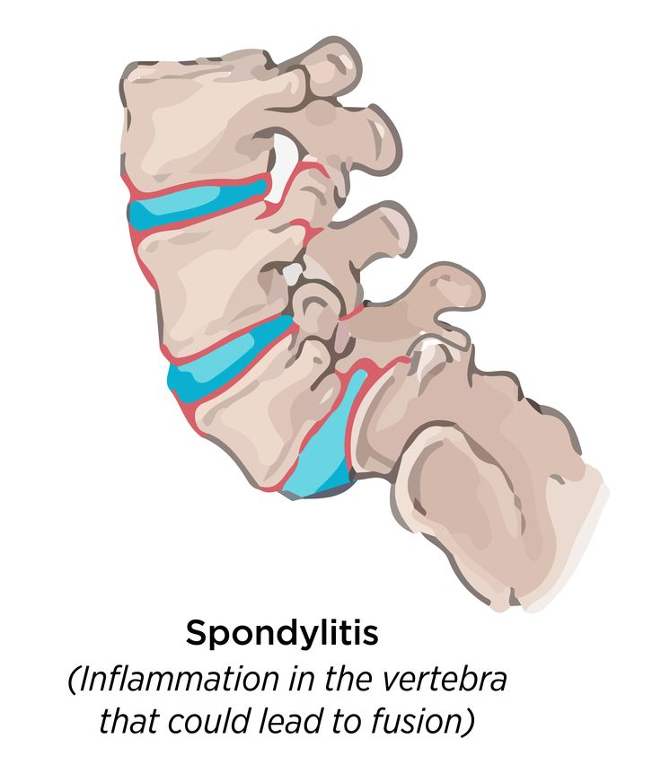 Spondylitis (With images)