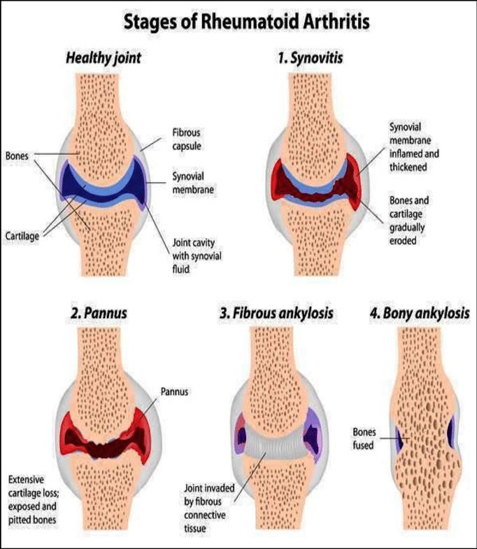 Stages of Rheumatoid arthritis