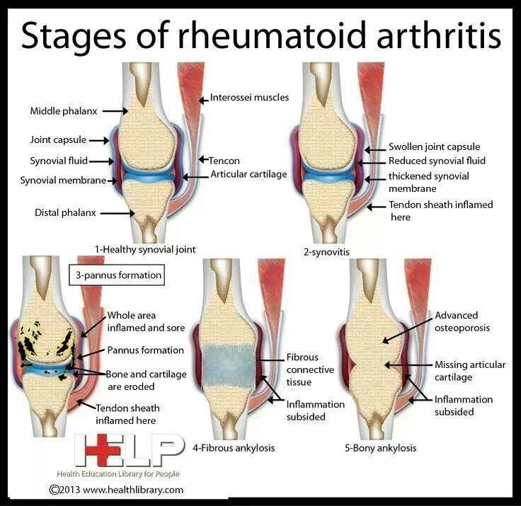 Stages of rheumatoid disease