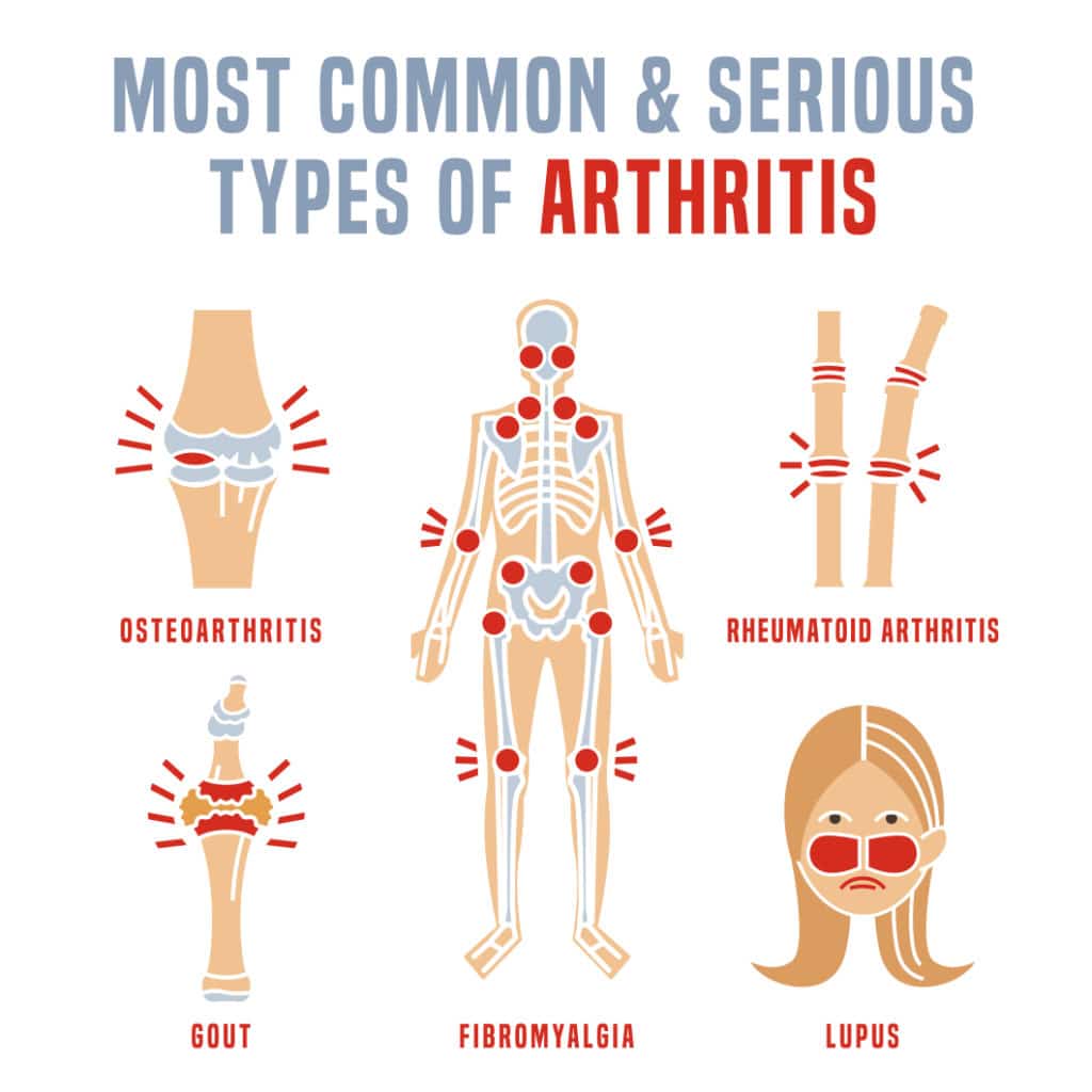 Steps to Reduce Your Risk Of Developing Some Types Of Arthritis