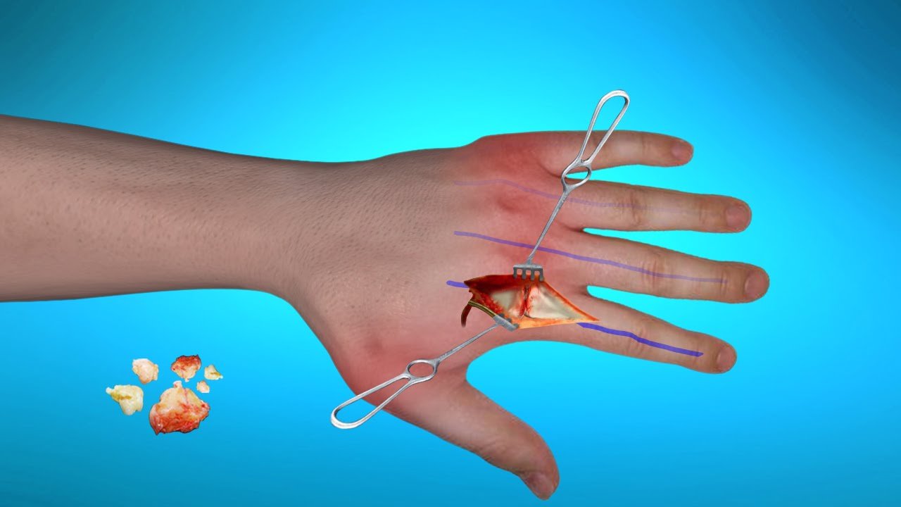 Surgical Treatment for Rheumatoid Arthritis of Hands