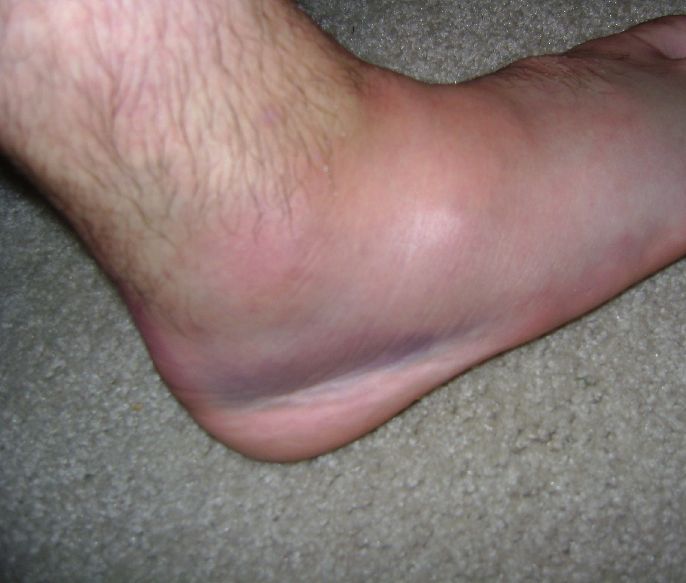 Swollen Feet And Ankles In Elderly