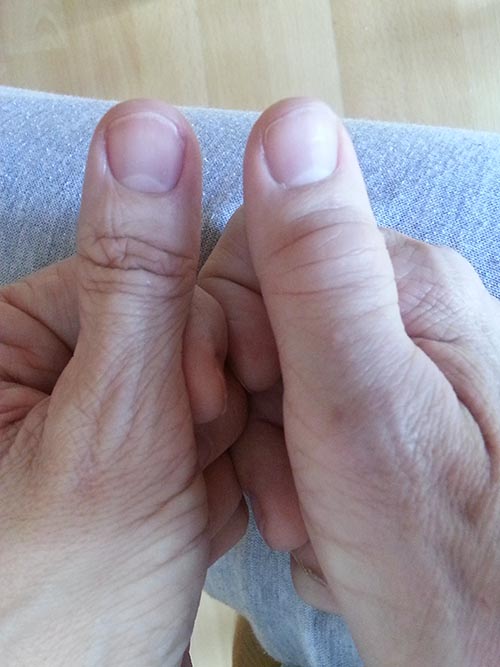 swollen right thumb joints