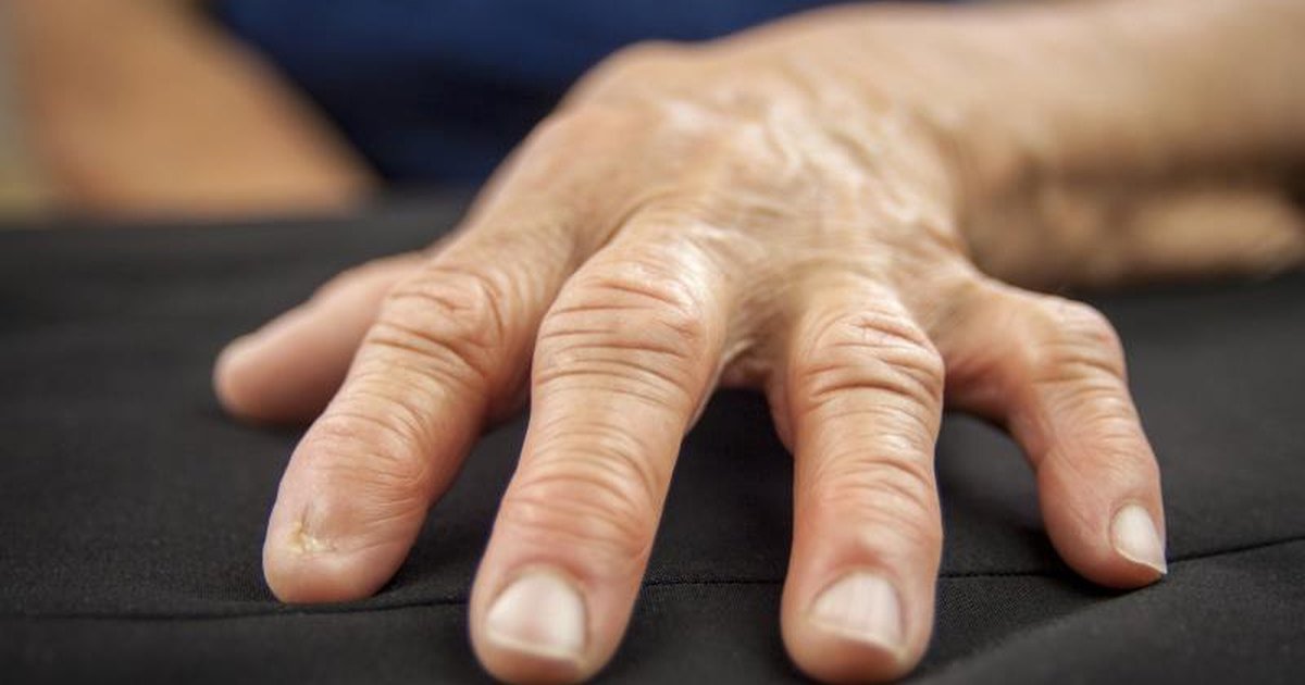 Symptoms of Rheumatoid Arthritis in the Hands and Fingers ...