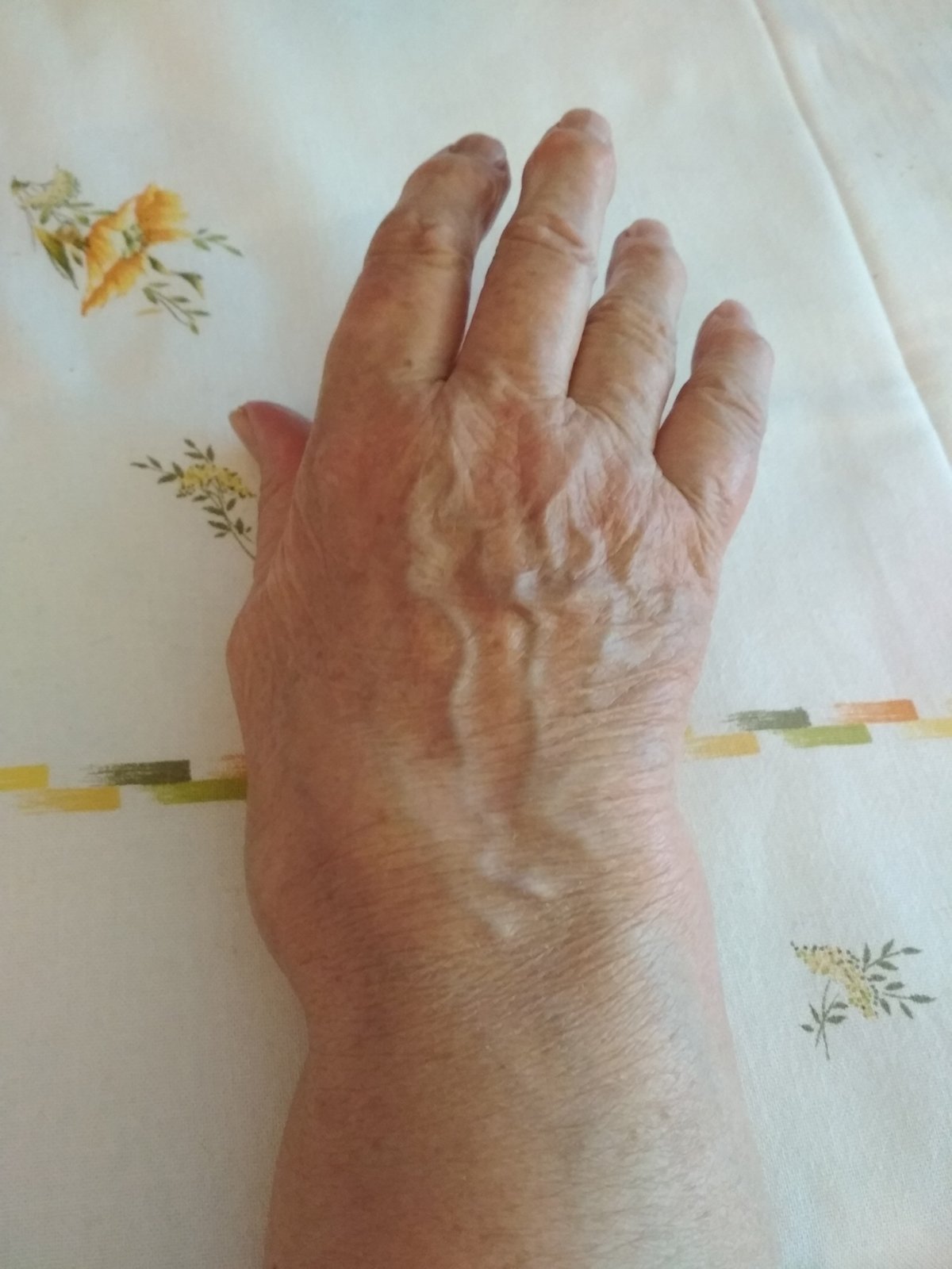Symptoms of wrist arthritis