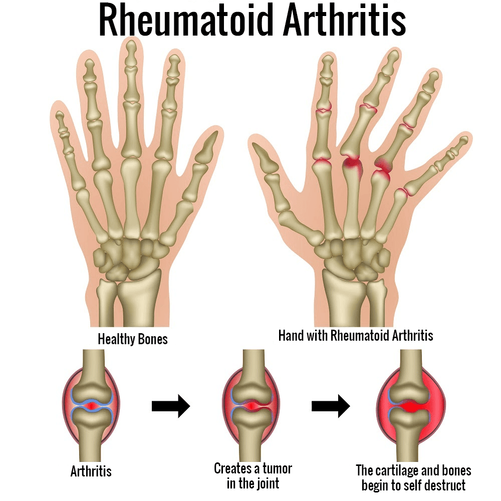 The Different Types of Arthritis in Recent Years