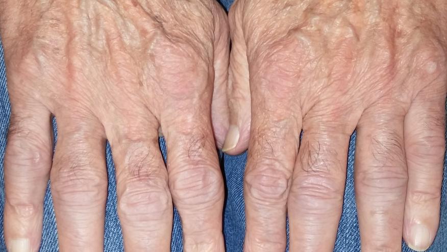 The Diverse Fate of Seronegative Rheumatoid Arthritis