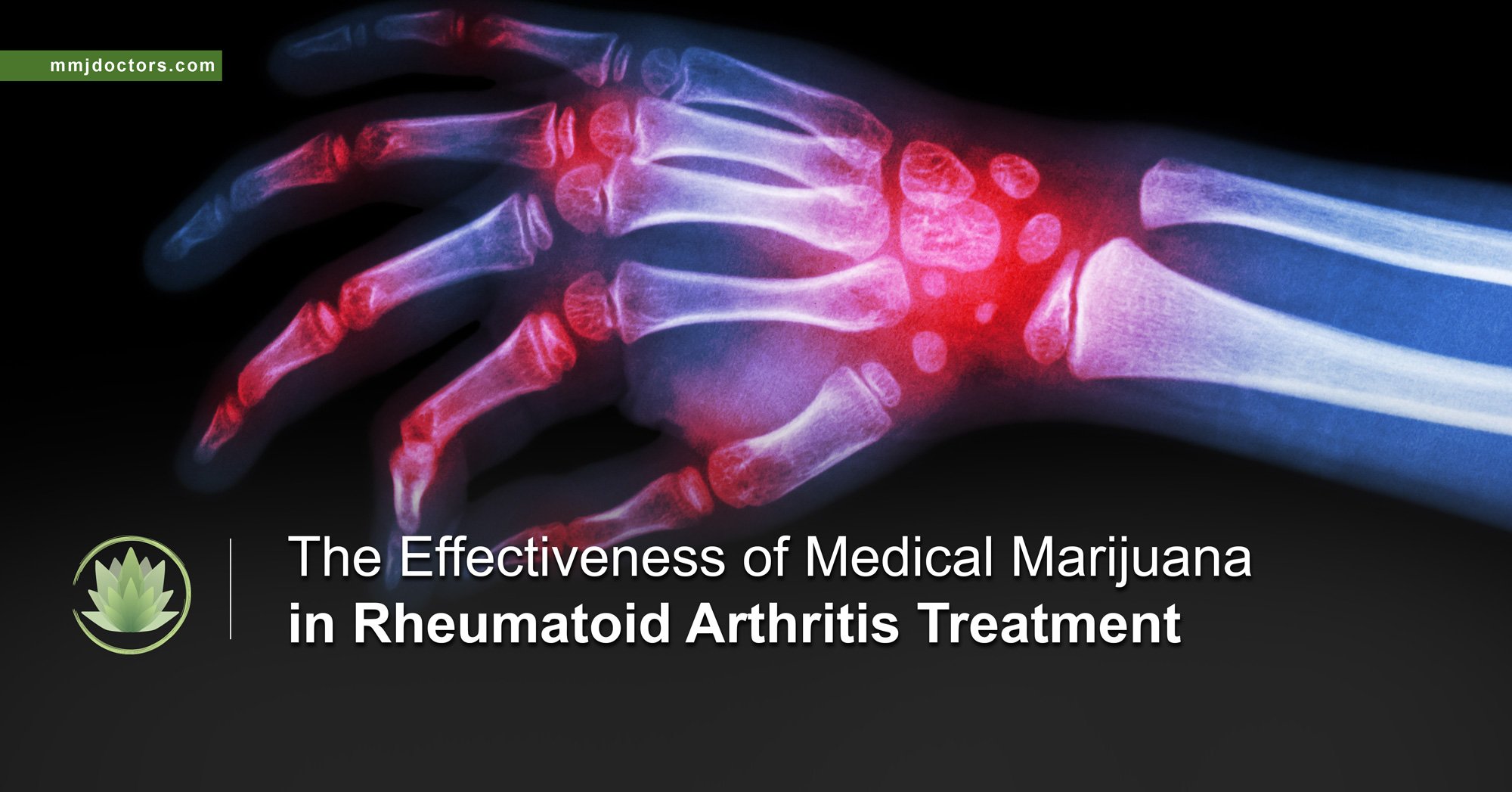 The Effectiveness of Medical Marijuana in Rheumatoid ...