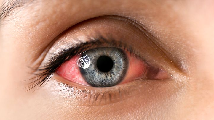 The Eyesight Threat Linked to Psoriatic Arthritis ...