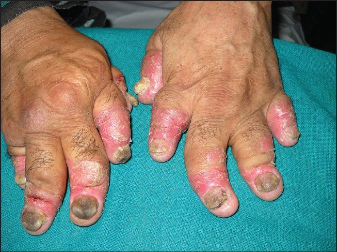 The pattern of psoriatic arthritis in Kashmir: A 6