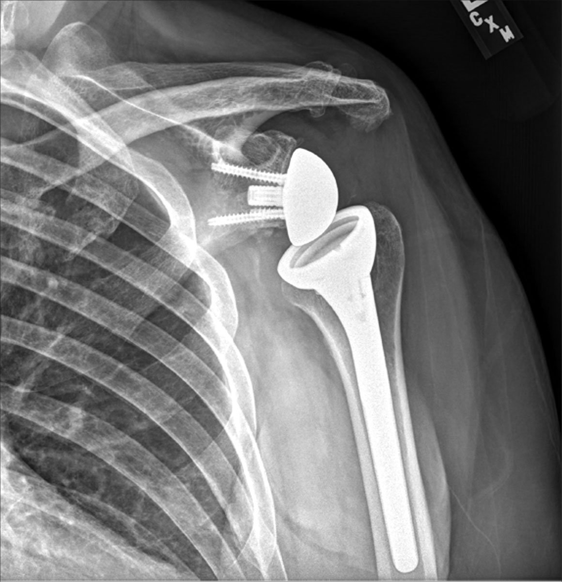 The Why and When of Shoulder Replacement Surgery