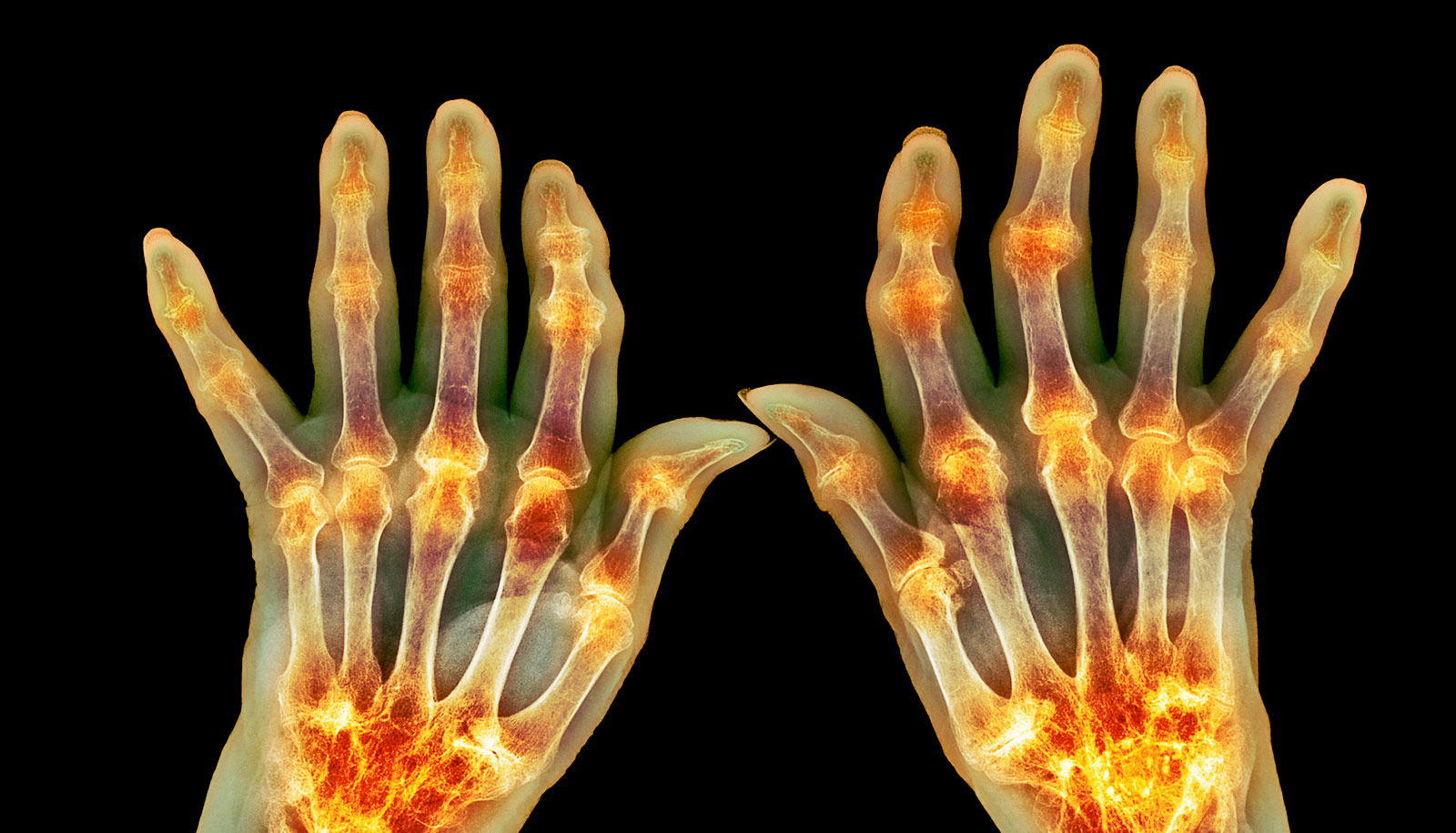 These cells spike before rheumatoid arthritis flare