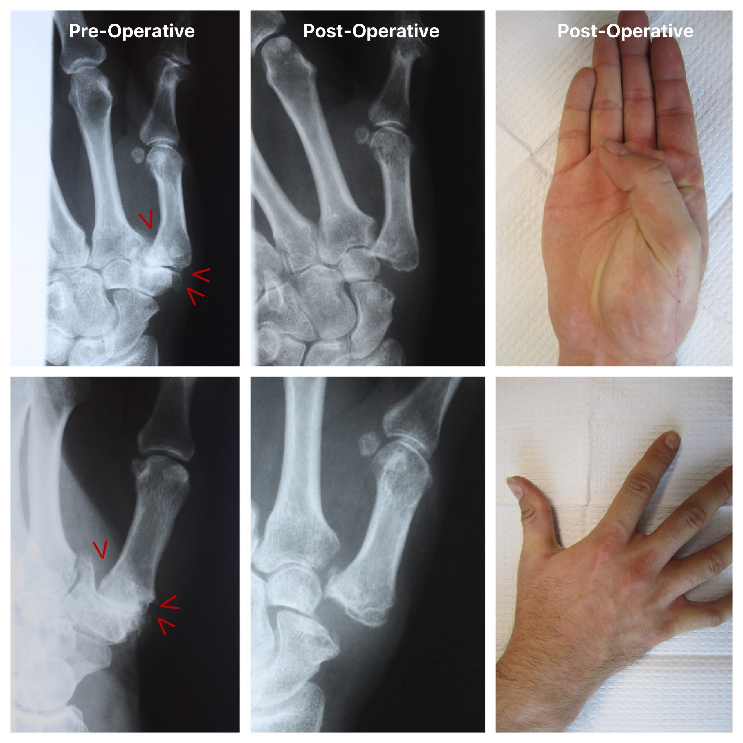 Thumb Arthritis Treatment in Raleigh by Dr. Erickson