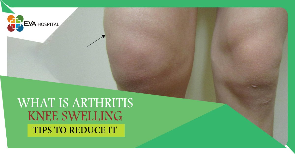 Tips To Reduce Arthritis Knee Swelling