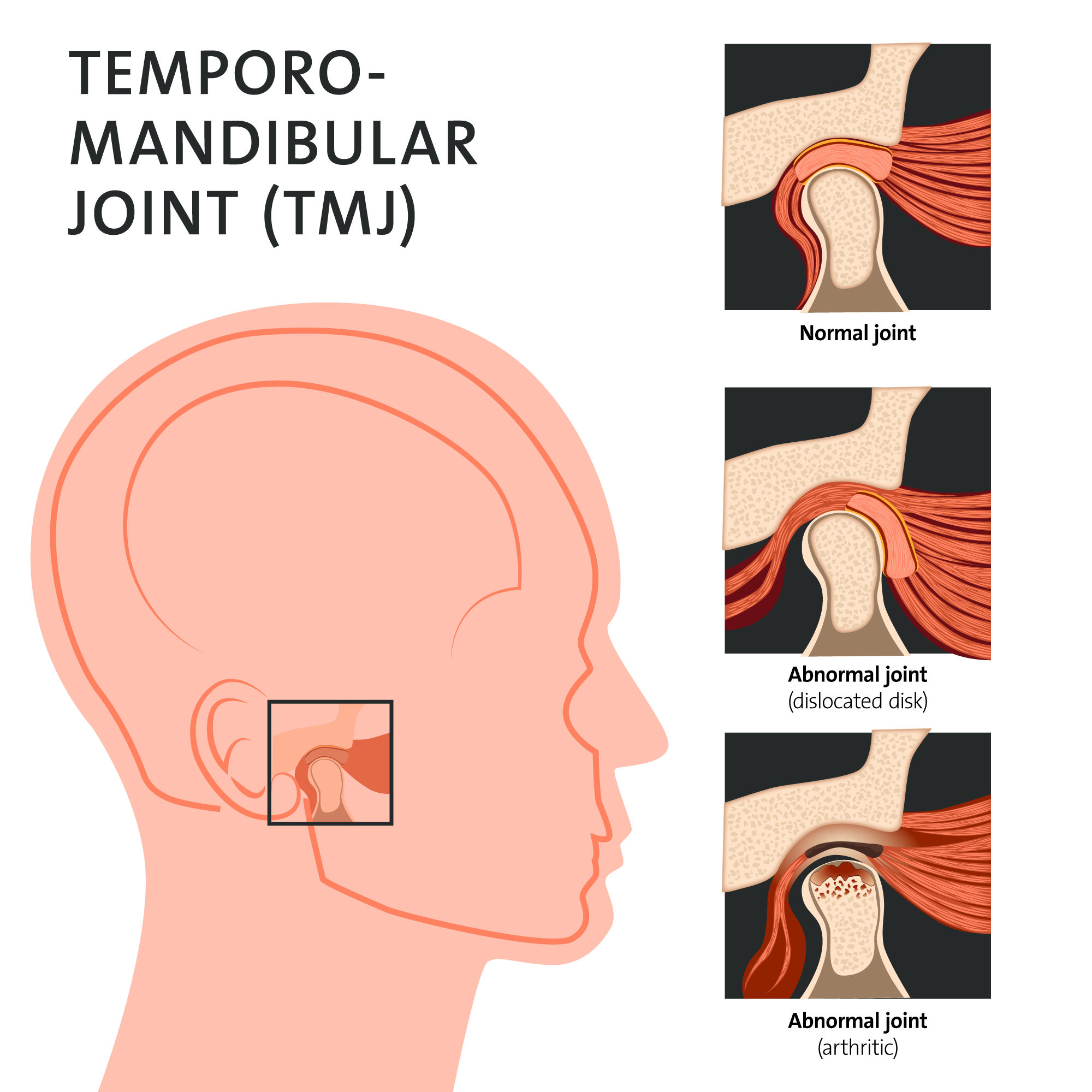 TMD Treatment and TMJ Treatment in San Jose