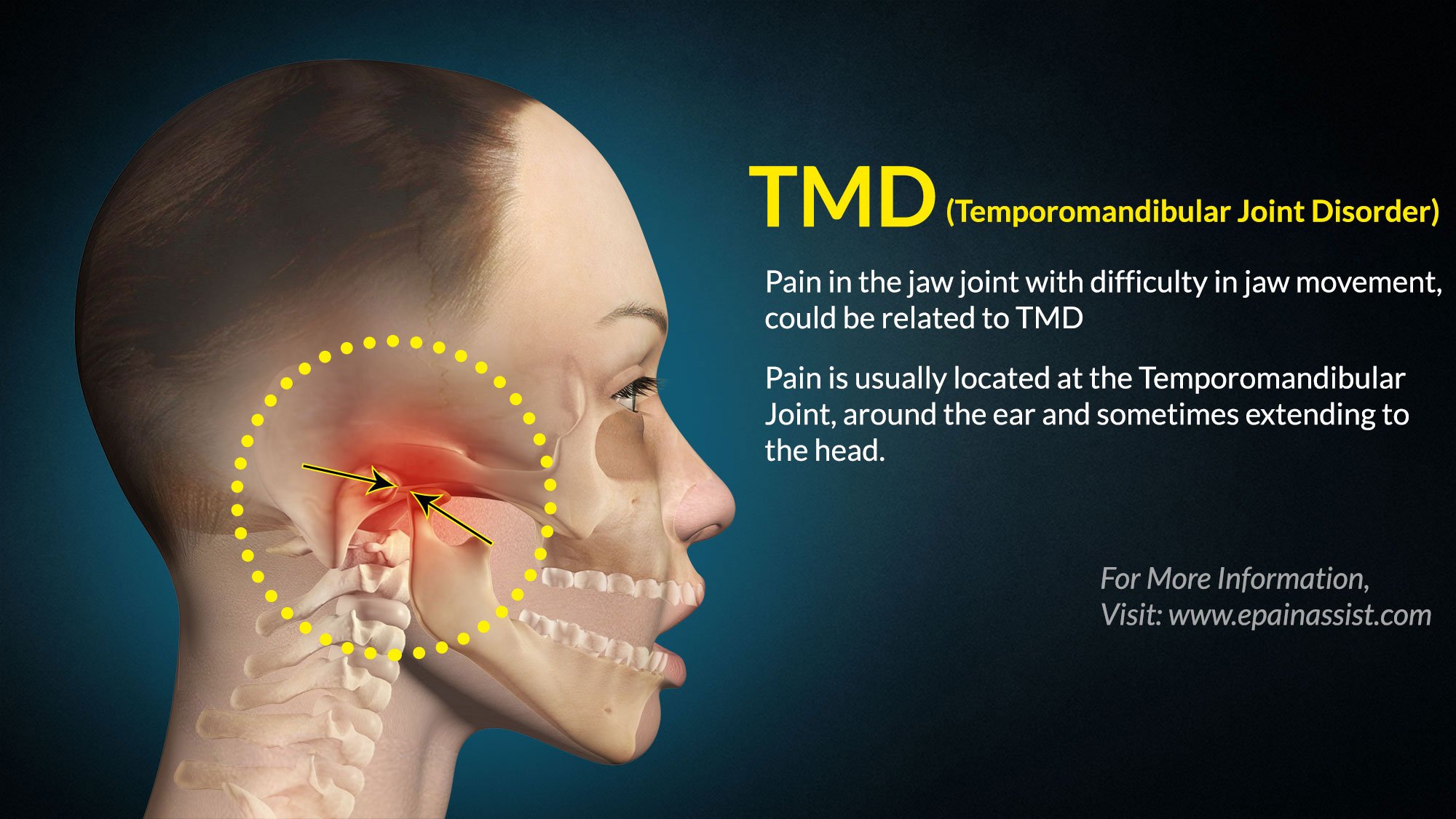 TMD: Treatment, Exercises, Tips, Causes, Symptoms, Diagnosis