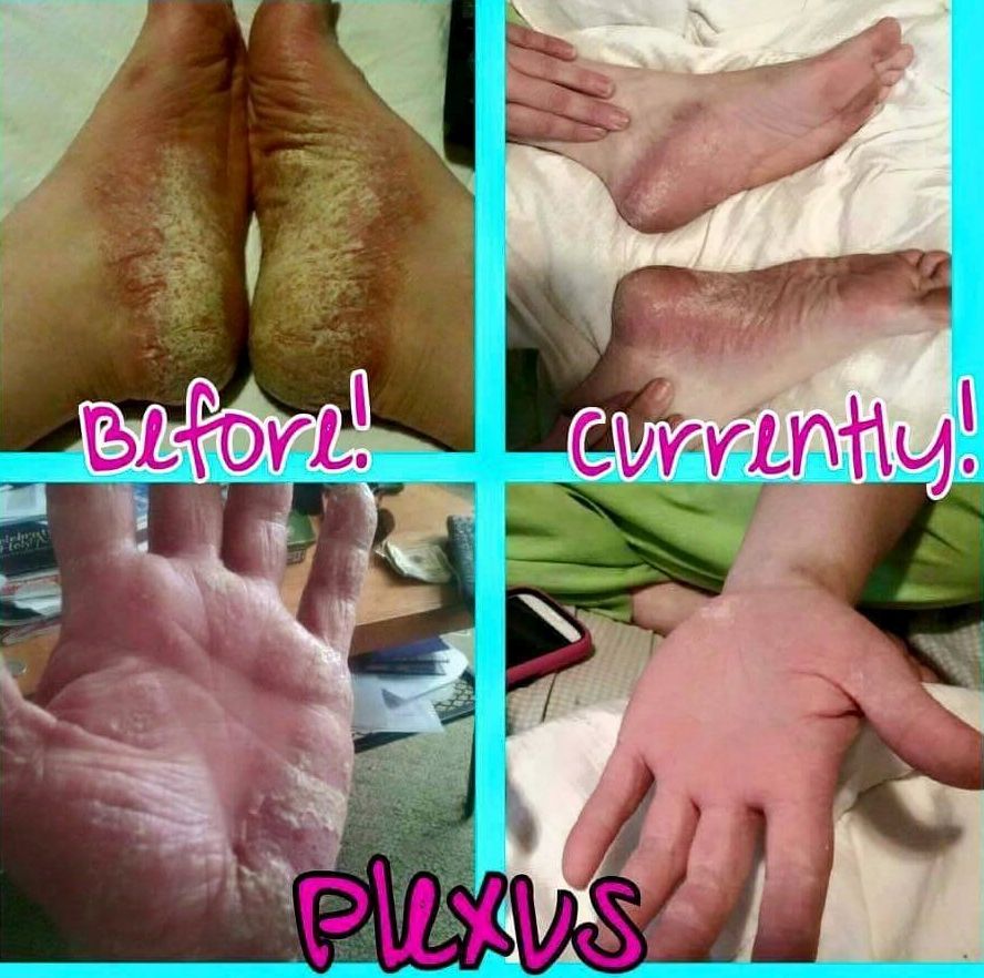 Tracie Roberts has been suffering from psoriatic arthritis. She has ...