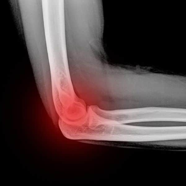 Treat Elbow Arthritis