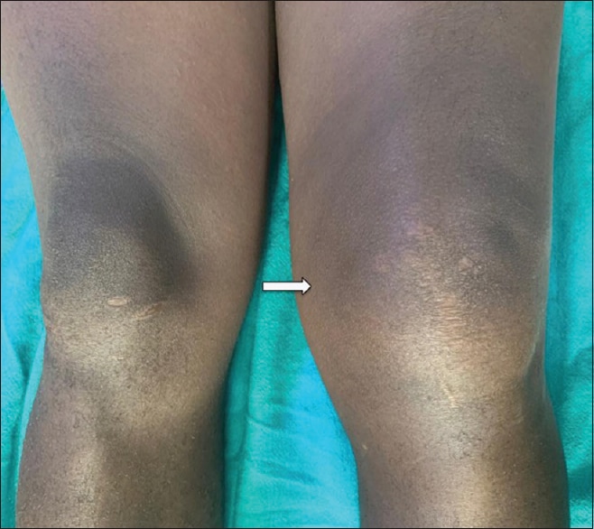 Tubercular arthritis of knee: Navigating the diagnostic dilemma Ghonge ...