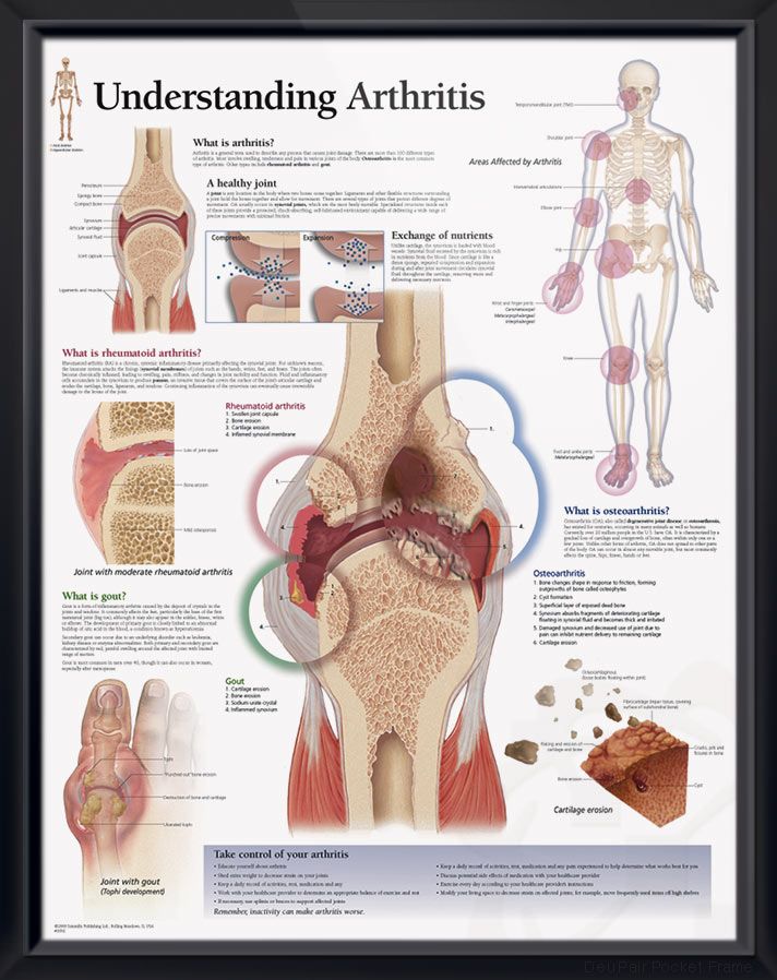 Understanding Arthritis anatomy poster details joints affected by ...