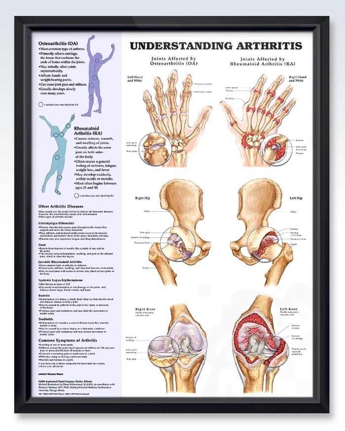 Understanding Arthritis Chart 20x26