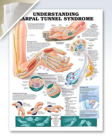 Understanding Carpal Tunnel Syndrome (d) 20x26