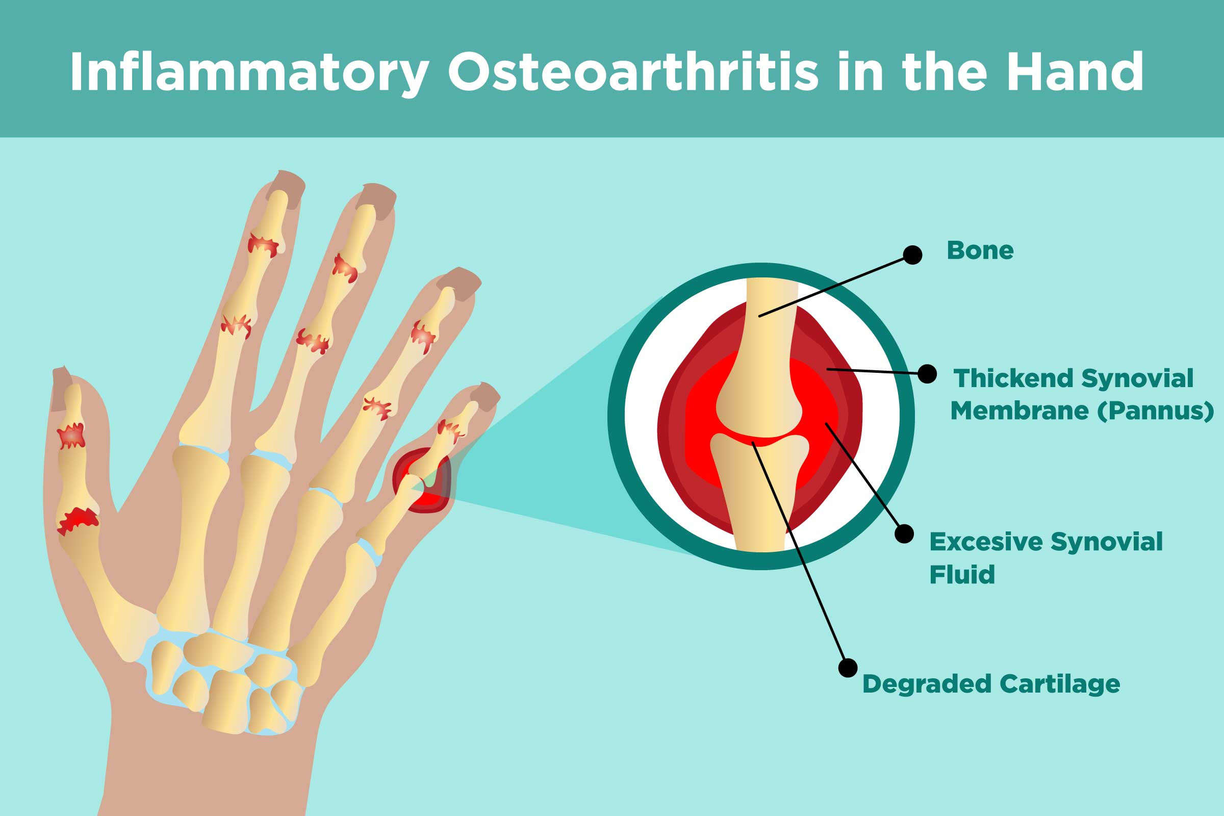 Understanding Erosive Osteoarthritis: Causes, Symptoms ...