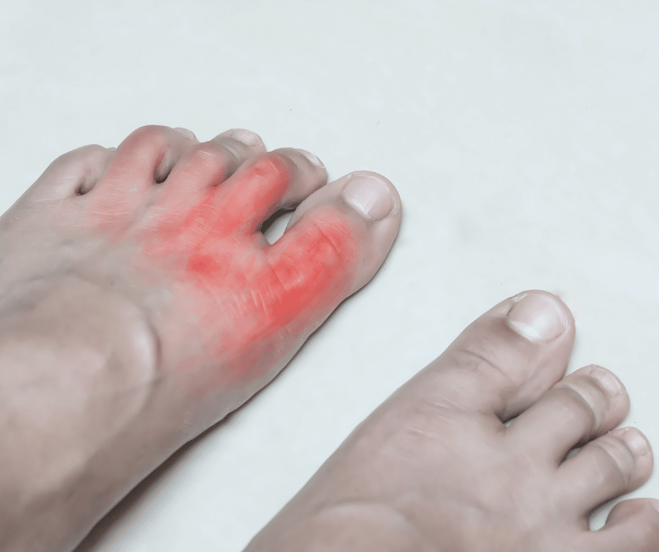 Understanding Foot &  Ankle Arthritis