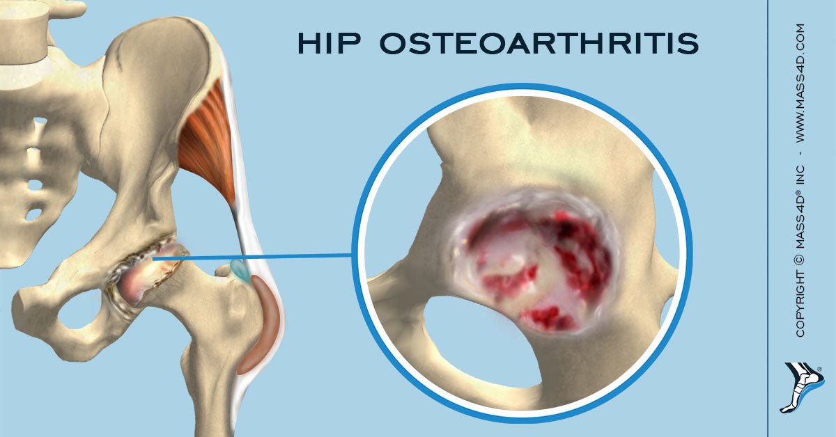 Understanding Hip Osteoarthritis